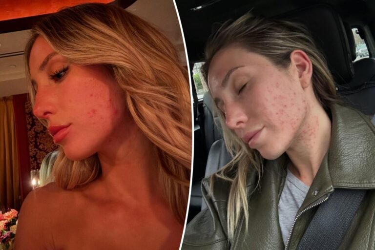 Alix Earle ditches make-up in public amid a blistering breakout Alix Earle ditches make-up in public amid a blistering breakout