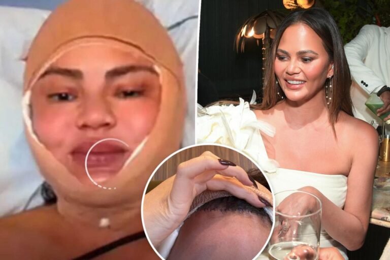 Chrissy Teigen will get hairline lowered in stunning process