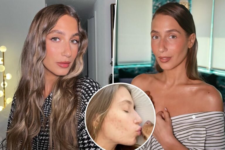 Amanda Batula will get actual about her pimples struggles and the merchandise that helped