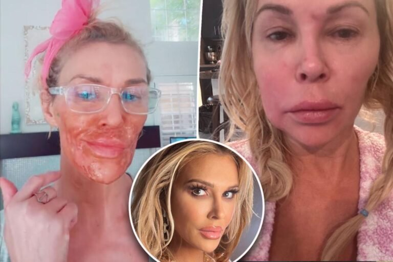 Brandi Glanville seems like ‘such a loser’ as debilitating face parasite leaves her unable to pay payments